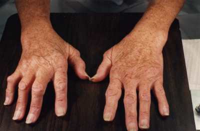 ревматоидный артрит